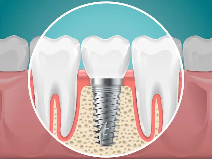 what are dental implants