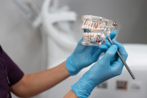 dental implants procedure step by step