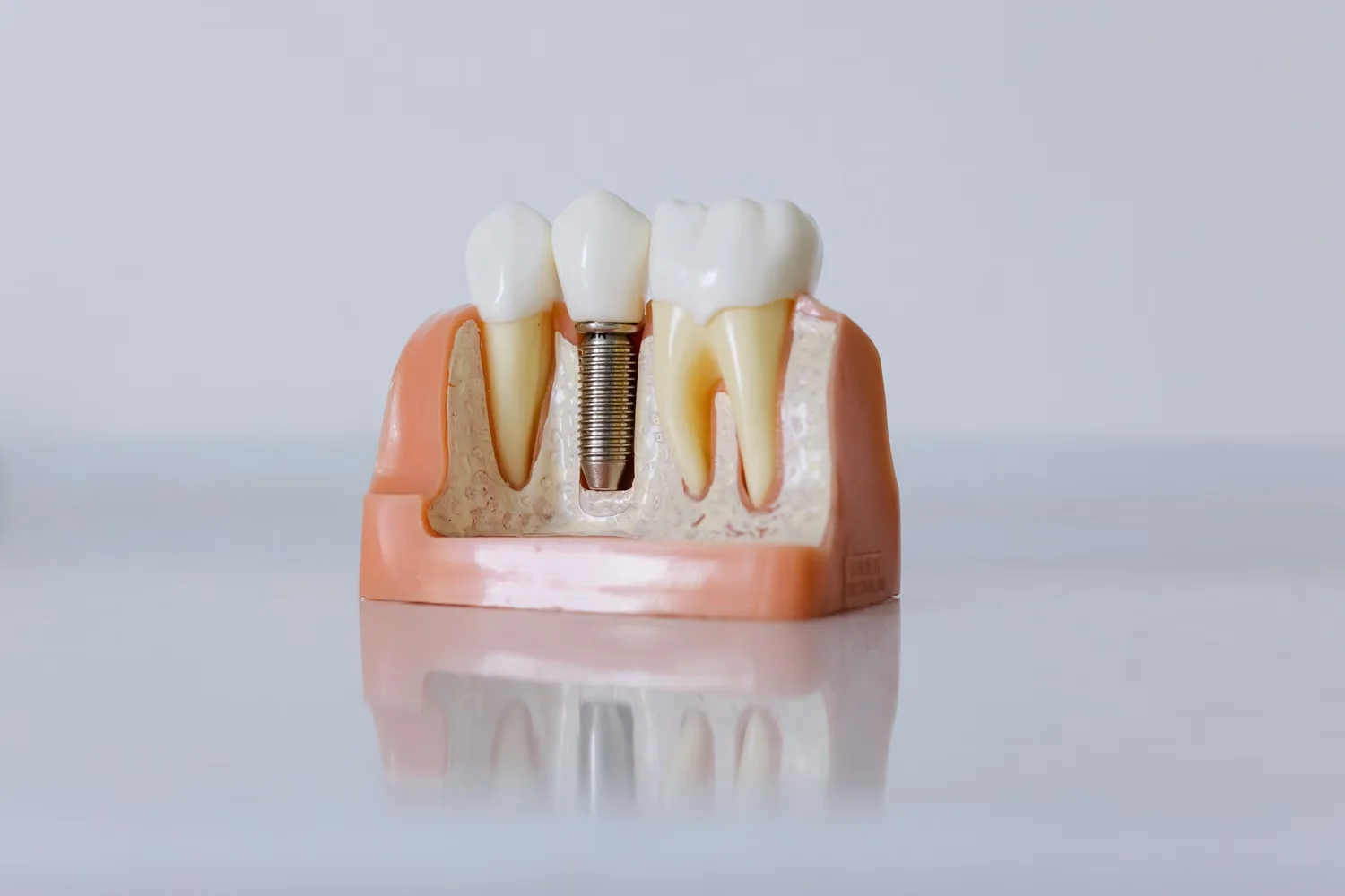 benefits of dental implants