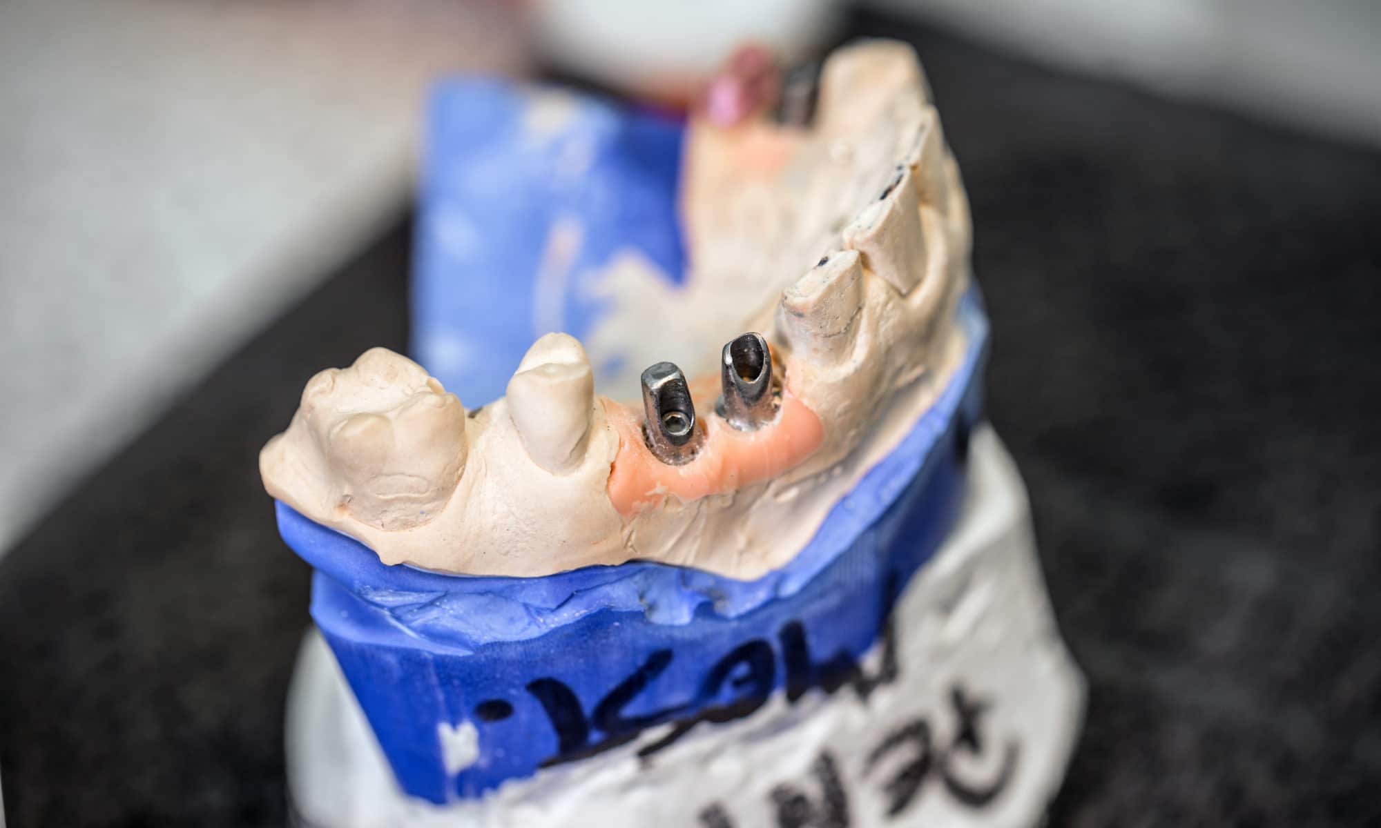 A Complete Guide to Dental Implants RiverRock Dental