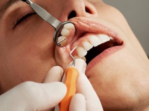 periodontitis treatment at home