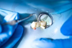tooth extraction vs root canal