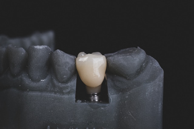 Full Mouth Dental Implants