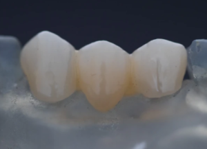 dental crowns