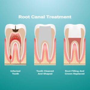 Root Canal Therapy