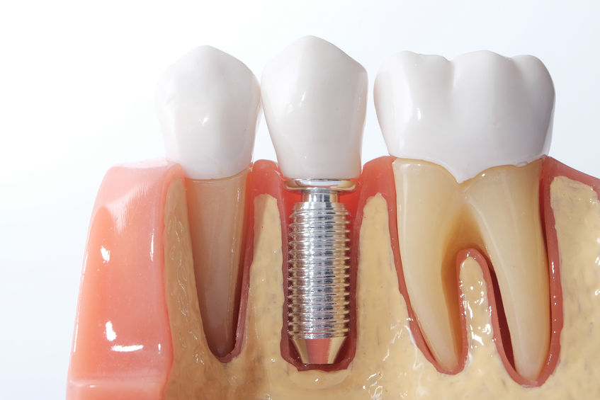 dental implants