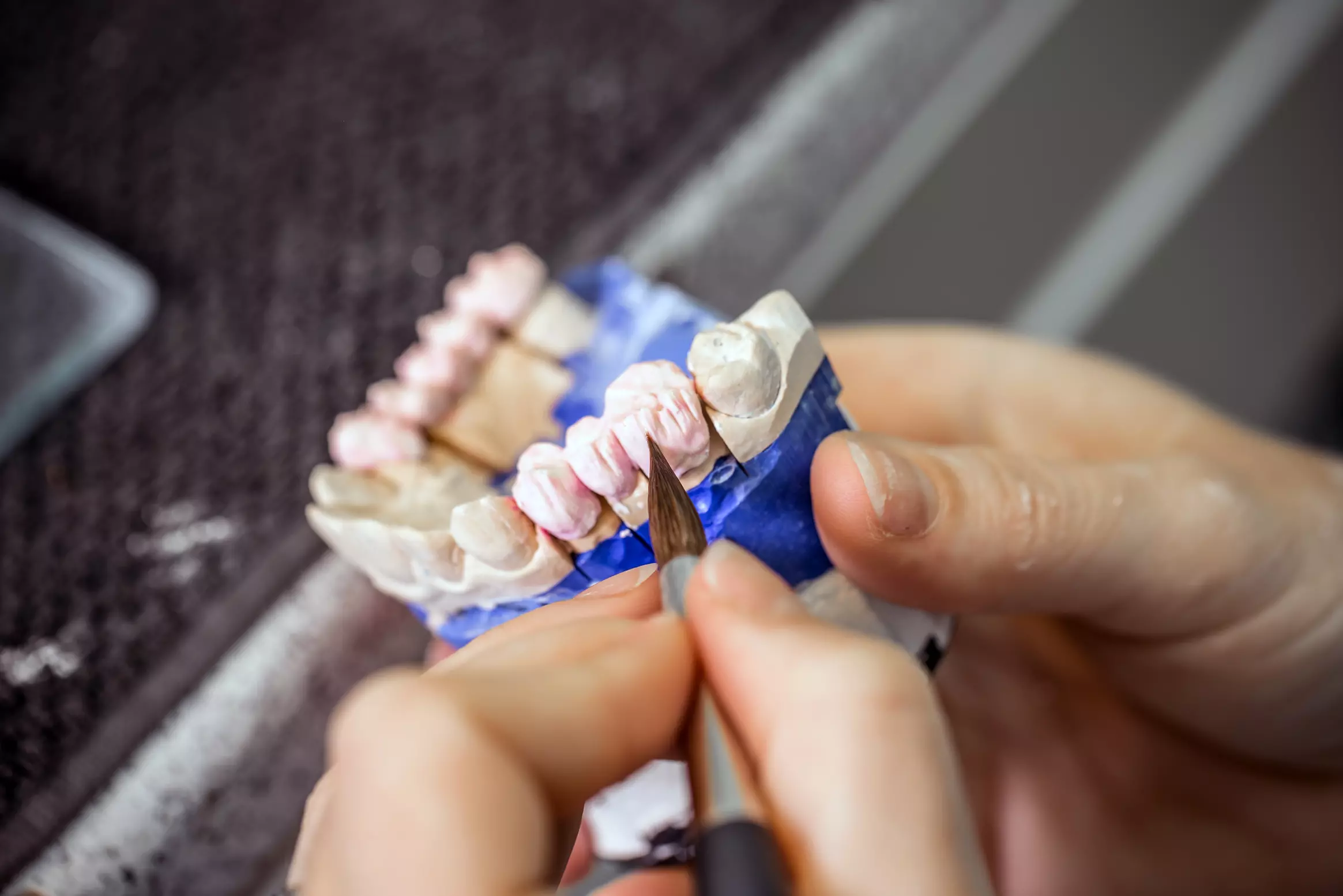 Dental Implants Vs Dentures