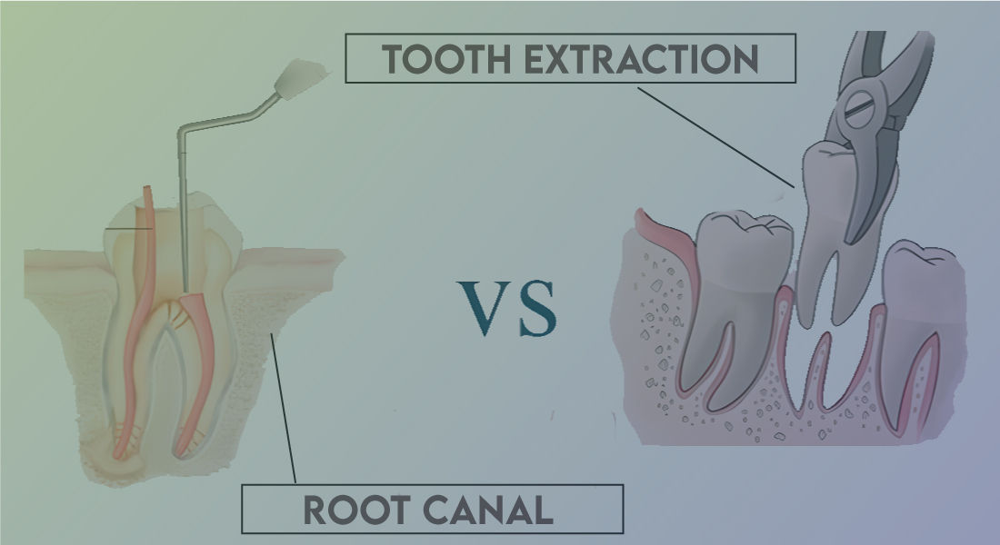 Root Canal Vs Extraction
