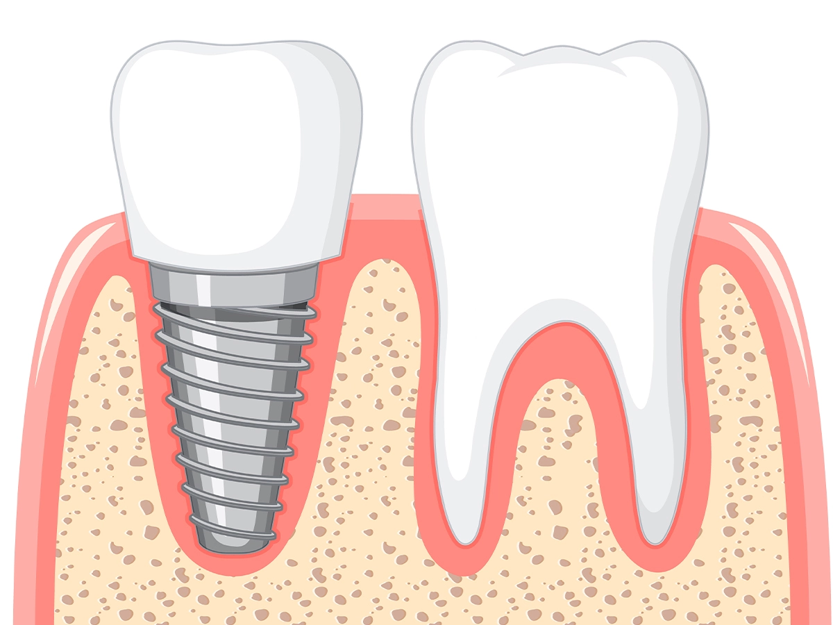 Dental Implant Pain