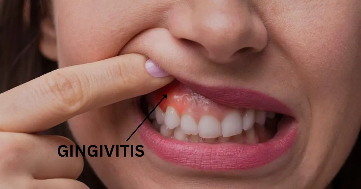 Gingivitis -Red Gums