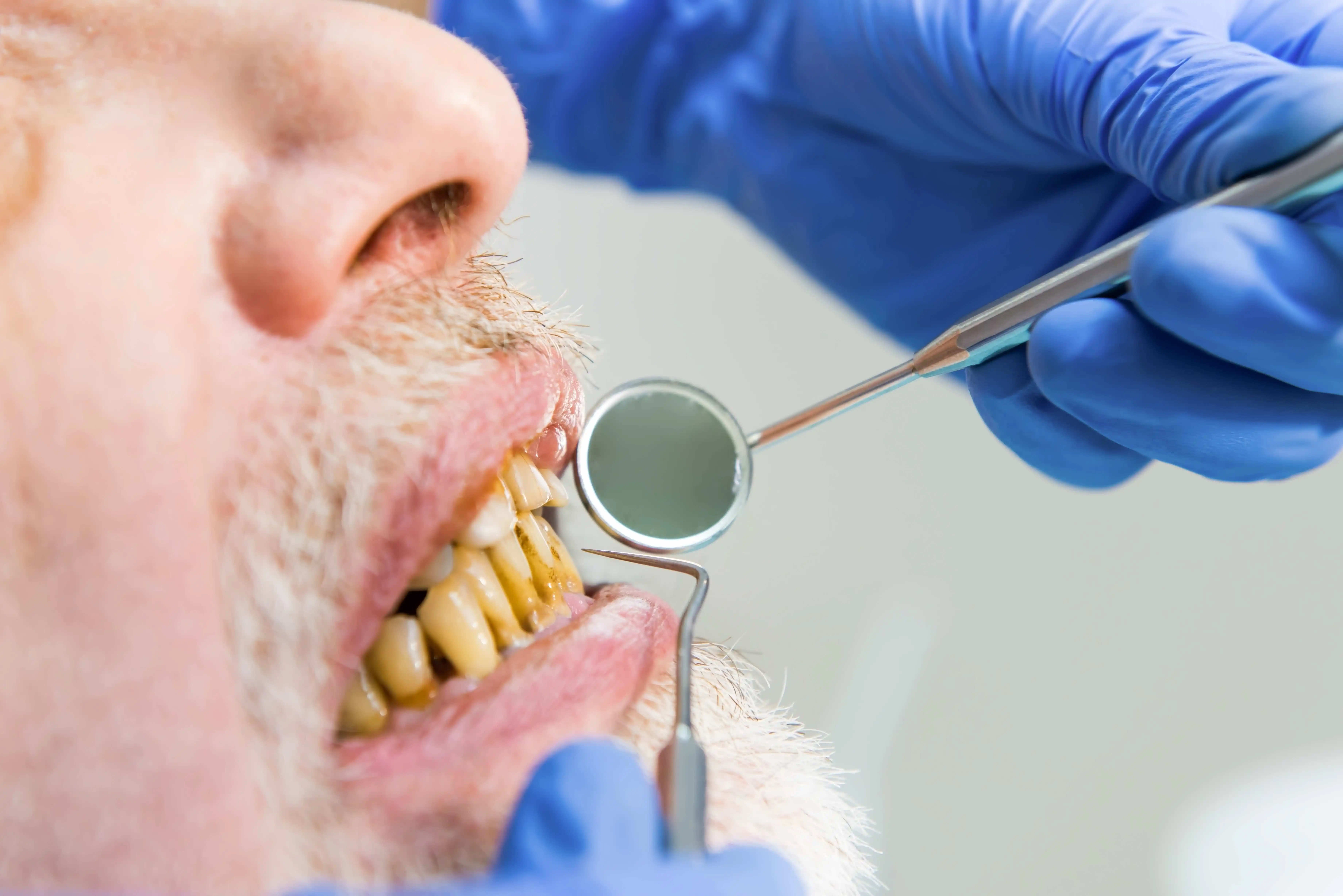 Periodontitis Treatment