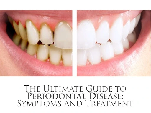 Periodontal Disease: Symptoms, Treatment