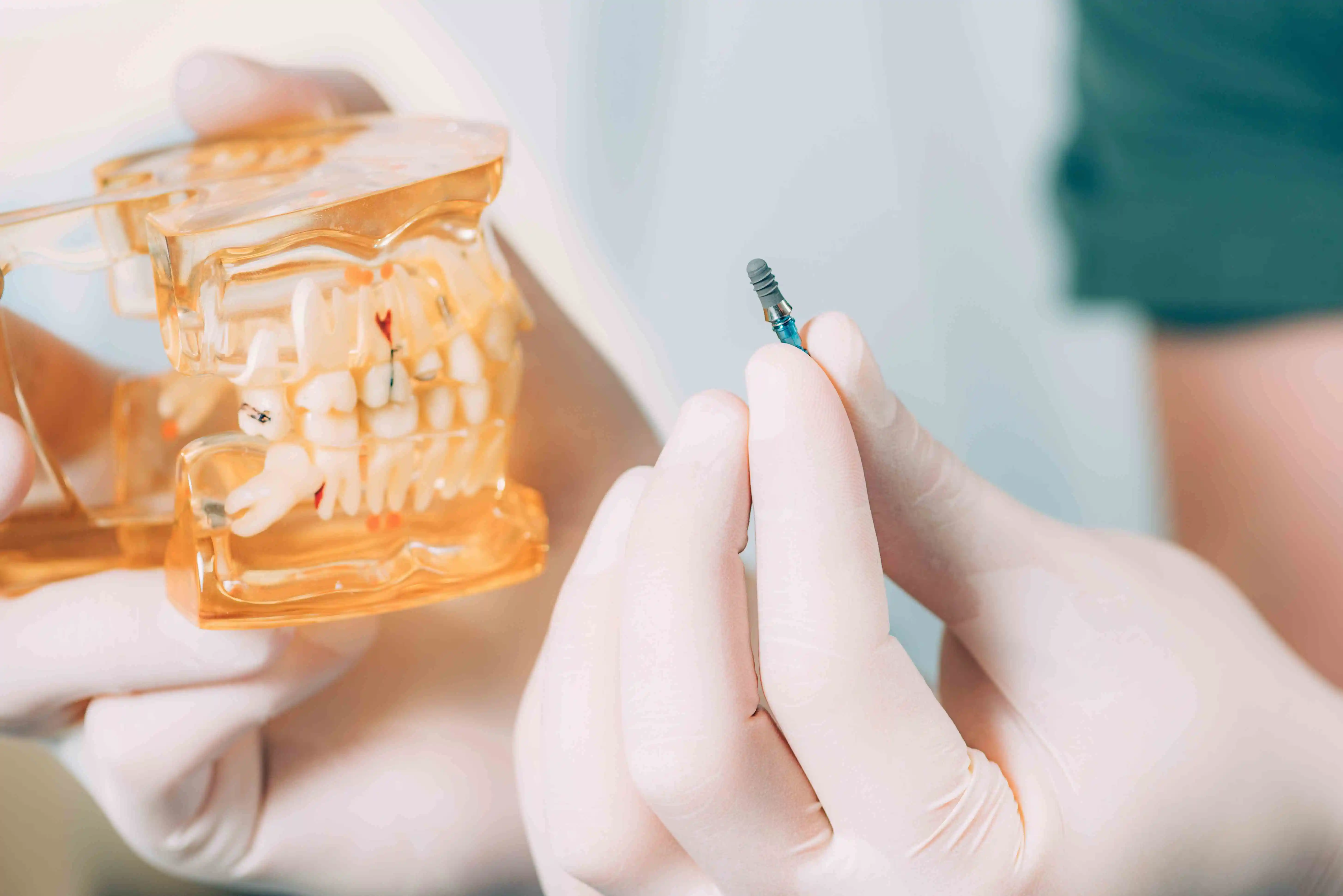 Five Reasons to Get a Dental Implant