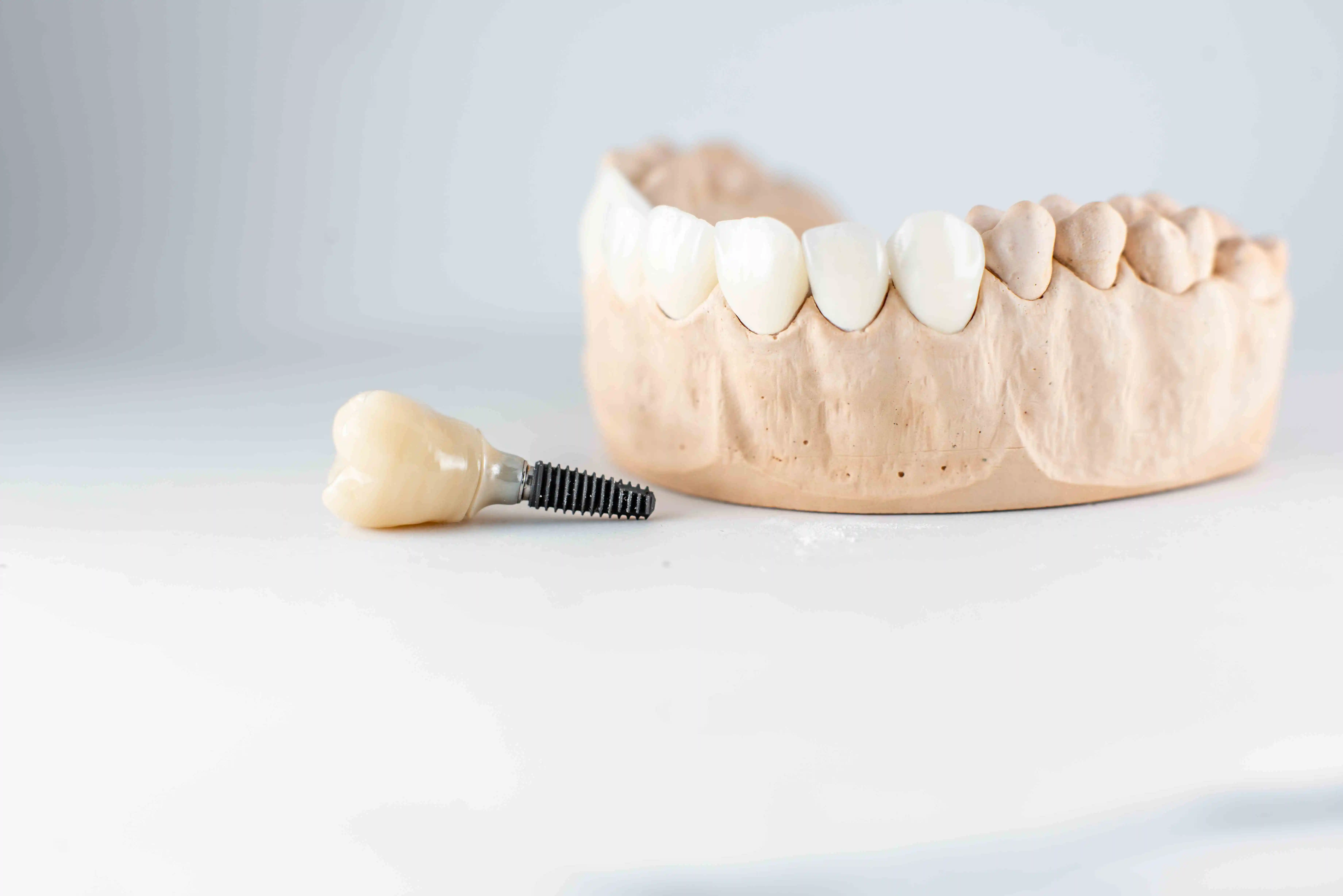 Reasons to Get a Dental Implant
