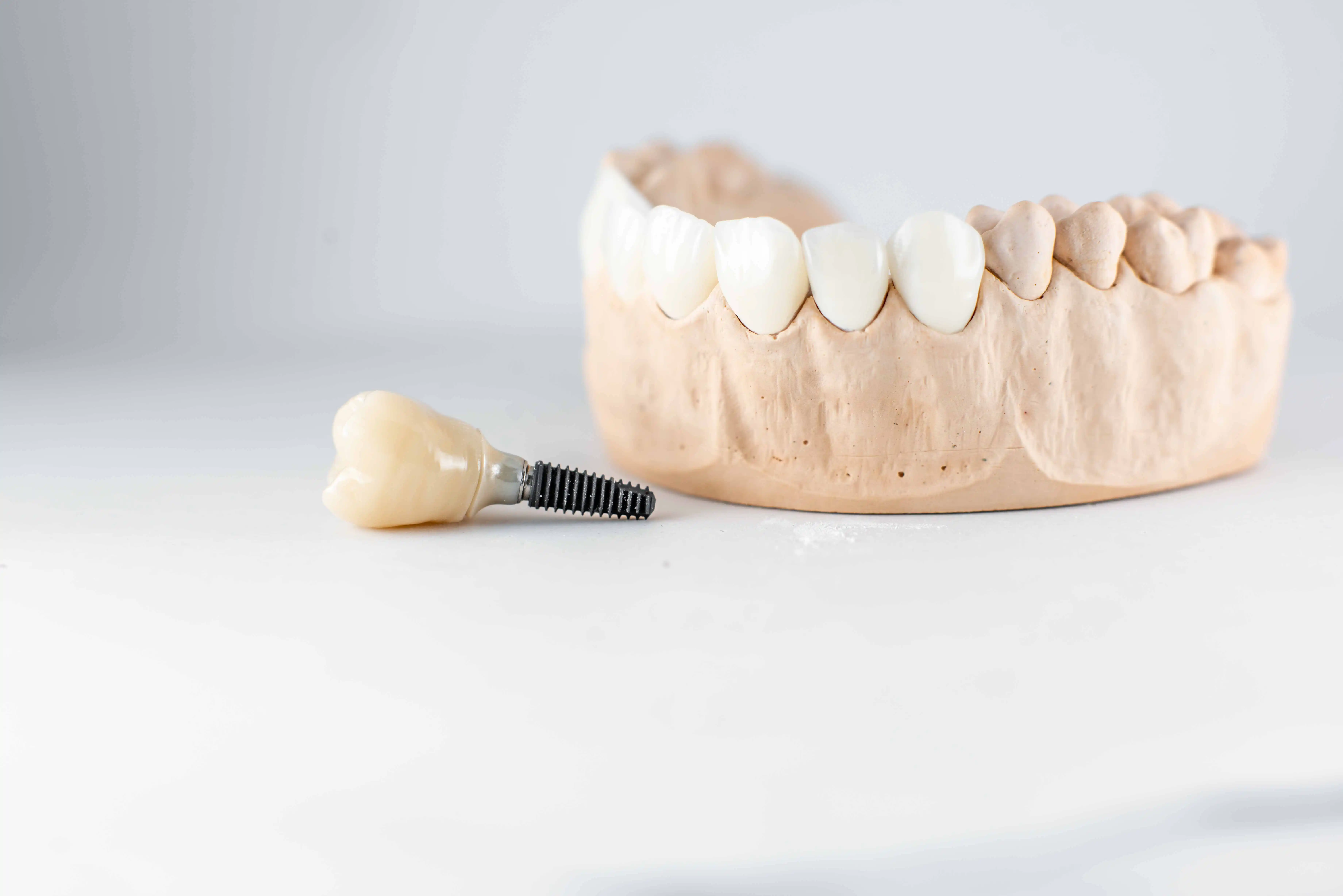artificial jaw and Dental Implant