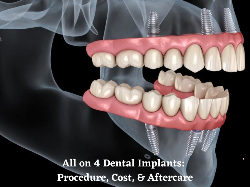 All on 4 Dental Implants Procedure Cost Aftercare