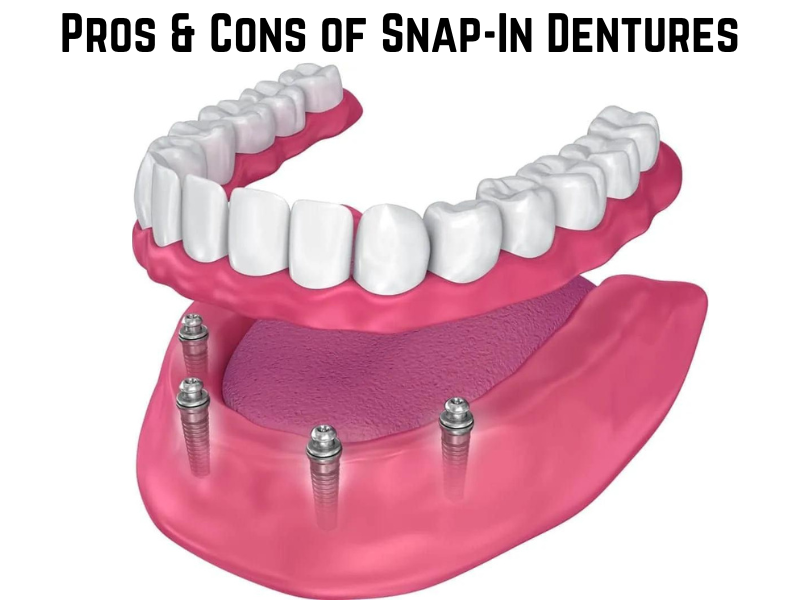 Pros & Cons of Snap-In Dentures