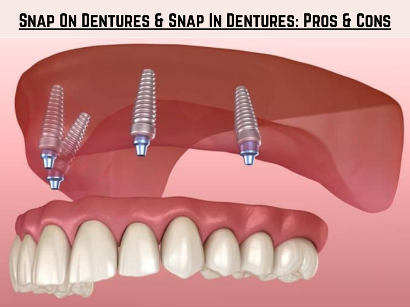 Snap On Dentures & Snap In Dentures Pros & Cons