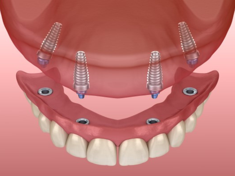 What are Snap-In Dentures