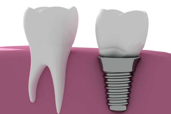 Dental Implants