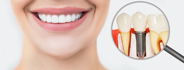 Am I a Good Candidate for Dental Implants