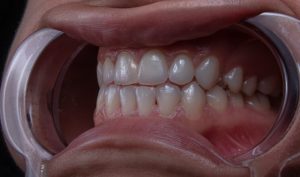 gum disease treatment