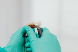 Dental Implants Supported Dentures