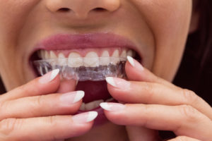 invisalign pros and cons