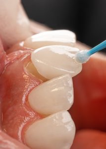 dental crown fell out​