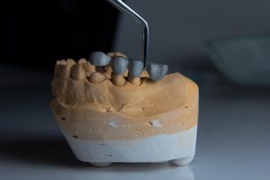 dental crown post fell out
