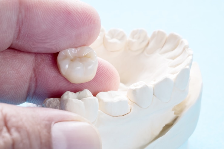 dental cap vs crown