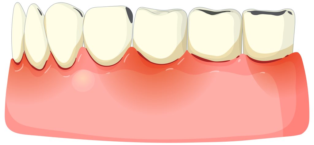 symptoms of gum disease