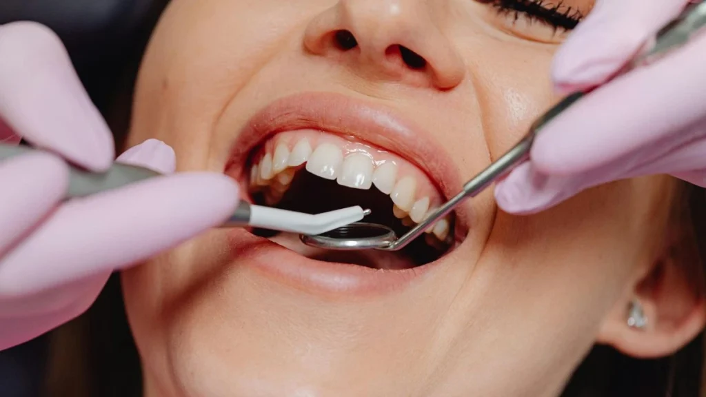 gingivitis vs periodontitis